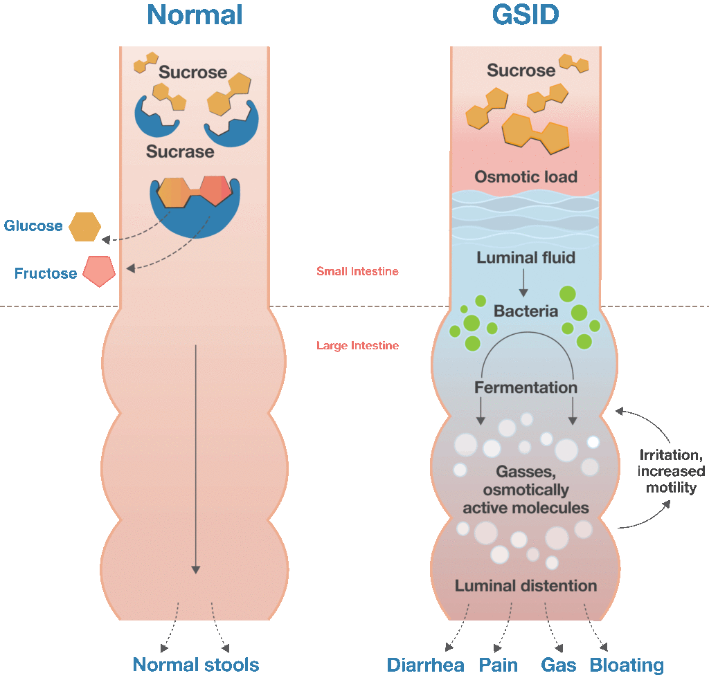 gsid-normal-digestion-csid-disease-information-congenital-sucrase